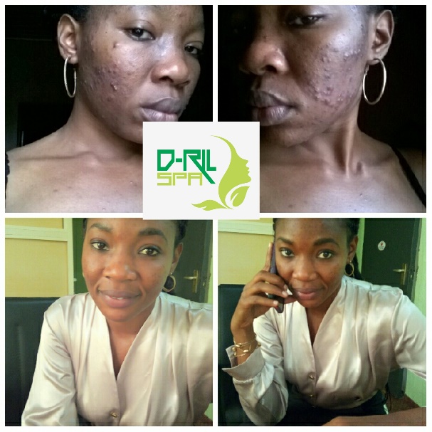 Dril-Spa Before and Photo facial treatment